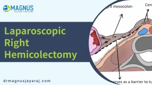 Laparoscopic right hemicolectomy | Dr. Magnus Jayaraj