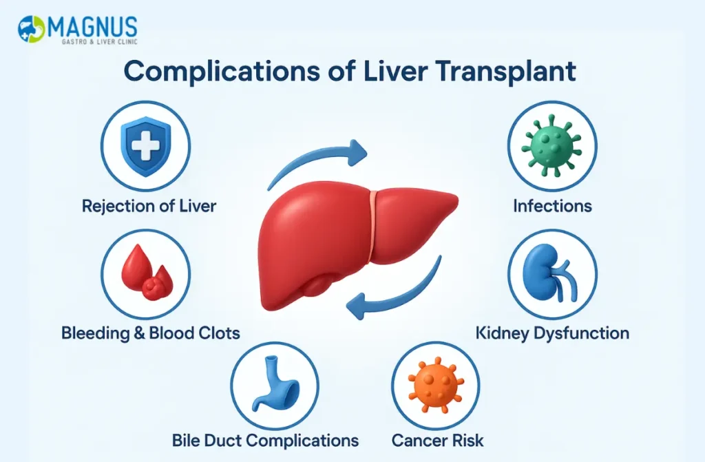 Liver Transplant For Cirrhosis