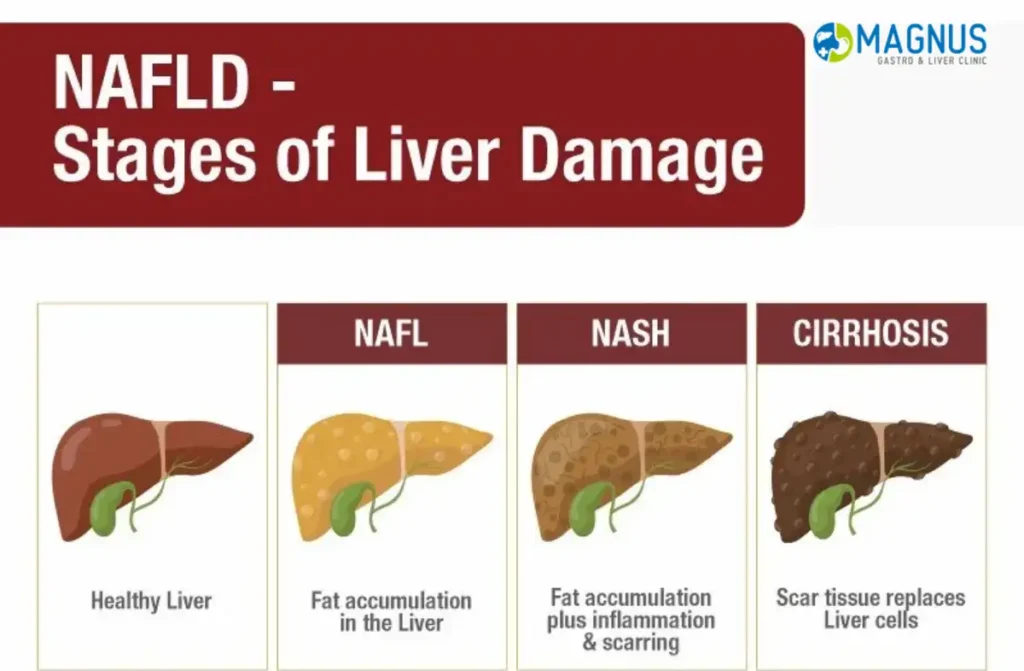Non Alcoholic Fatty Liver Disease Treatment