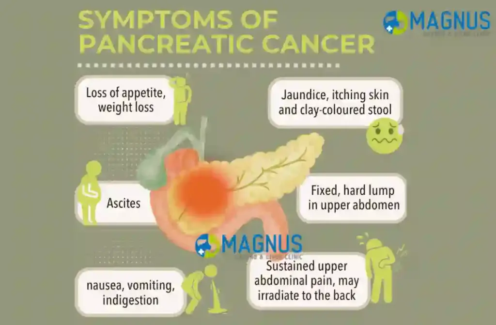 Stage 4 Pancreatic Cancer