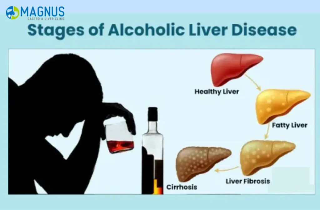 How Alcohol Affects Your Liver