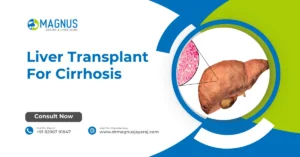 Liver Transplant For Cirrhosis