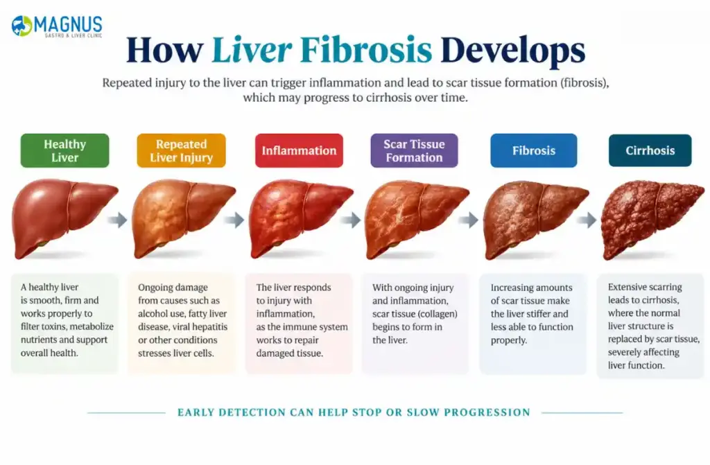 Liver Fibrosis Treatment
