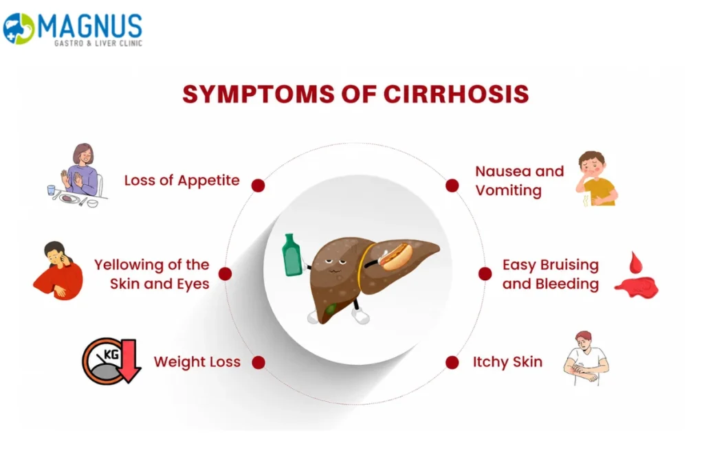 Liver Cirrhosis Treatment