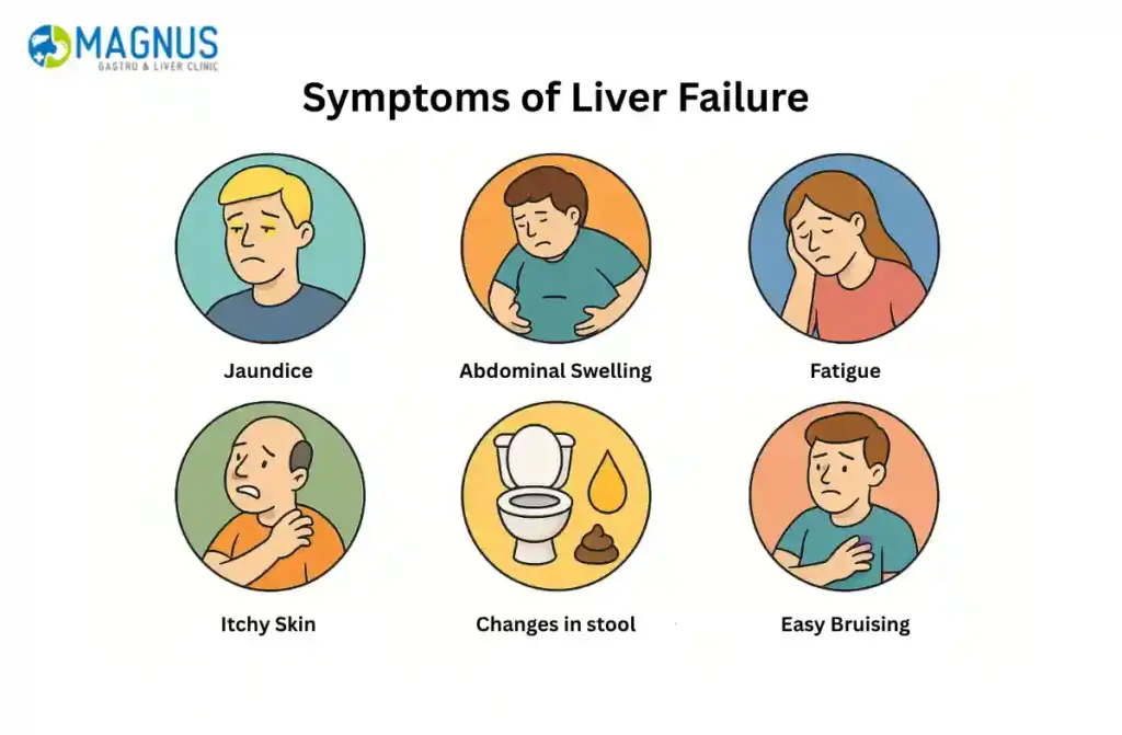 Signs of Liver Failure