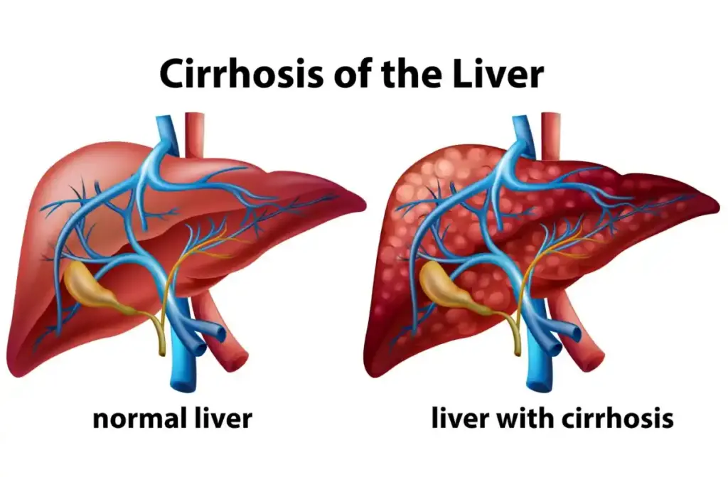 Liver Cirrhosis treatment in Chennai